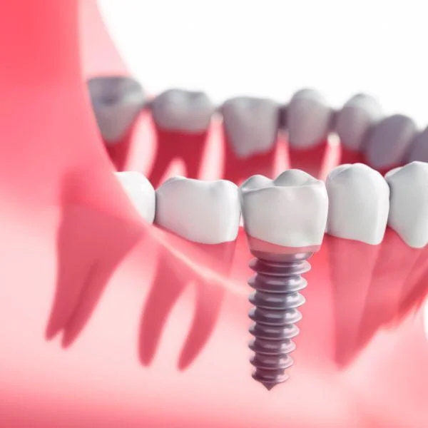 how soon after tooth extraction can you have an implant