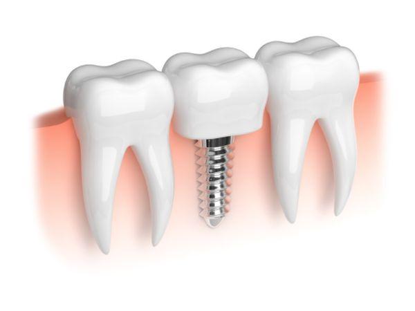 Dental implants after extraction
