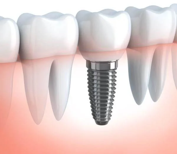 Single dental implant Cheshire