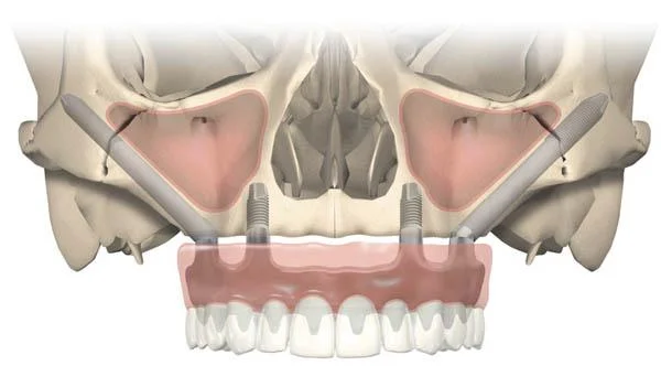 Zygomatic dental implants