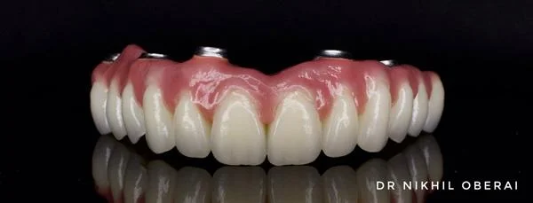Full Arch Dental Implants Dr Nikhil Oberai