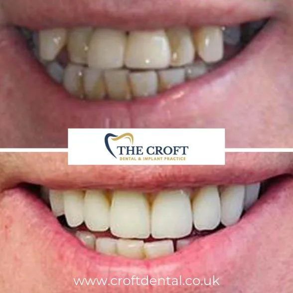 Dental Implants before and after 1