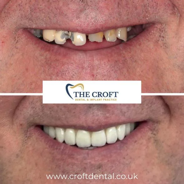 Dental Implants before and after 5