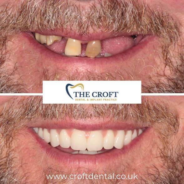 Dental Implants before and after 6