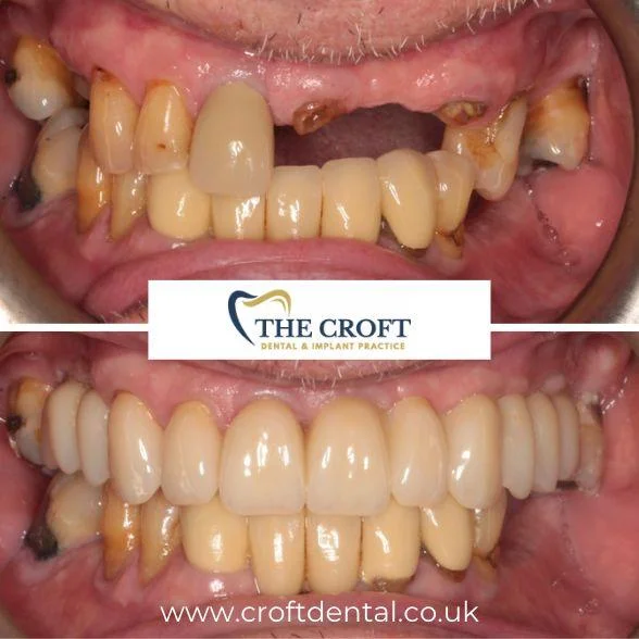 Dental implants before and after wilmslow 8