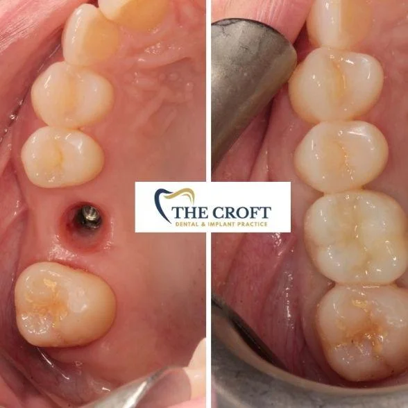 Dental Implants Before & After 10