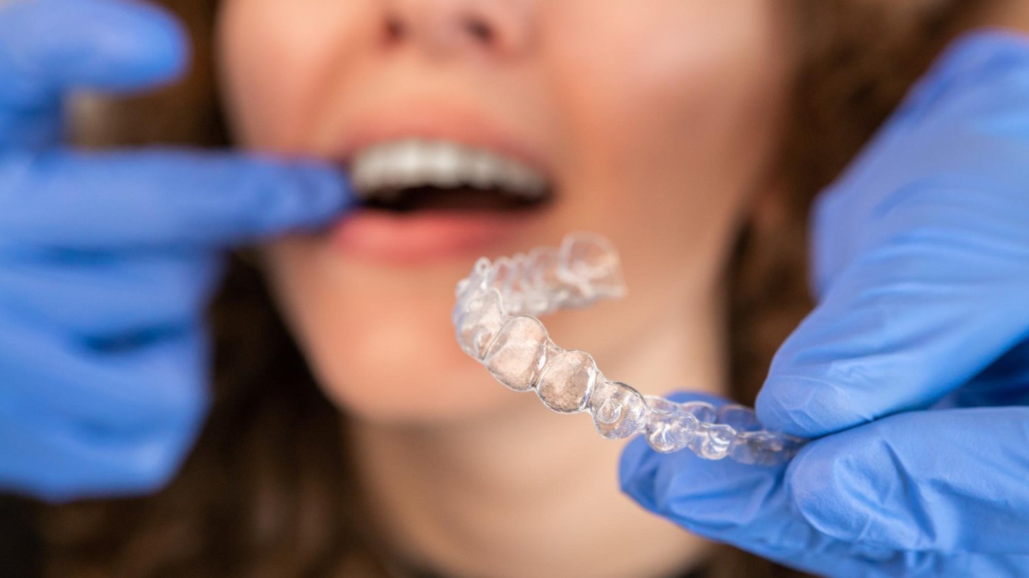 Invisalign