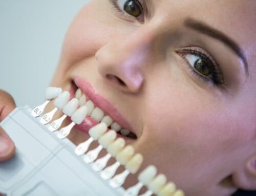 Why Teeth Whitening Is Worth It For A Special Occasion