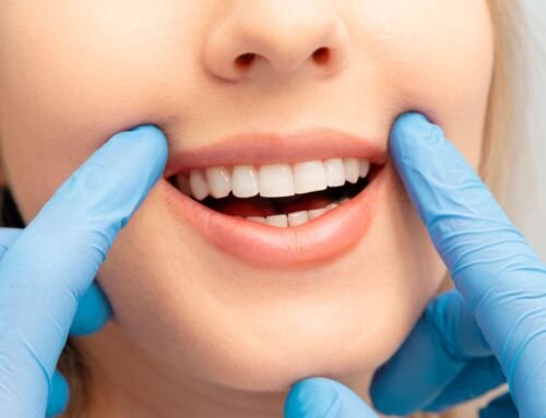 Composite Bonding: Fixing Discolored Teeth in Alderley Edge