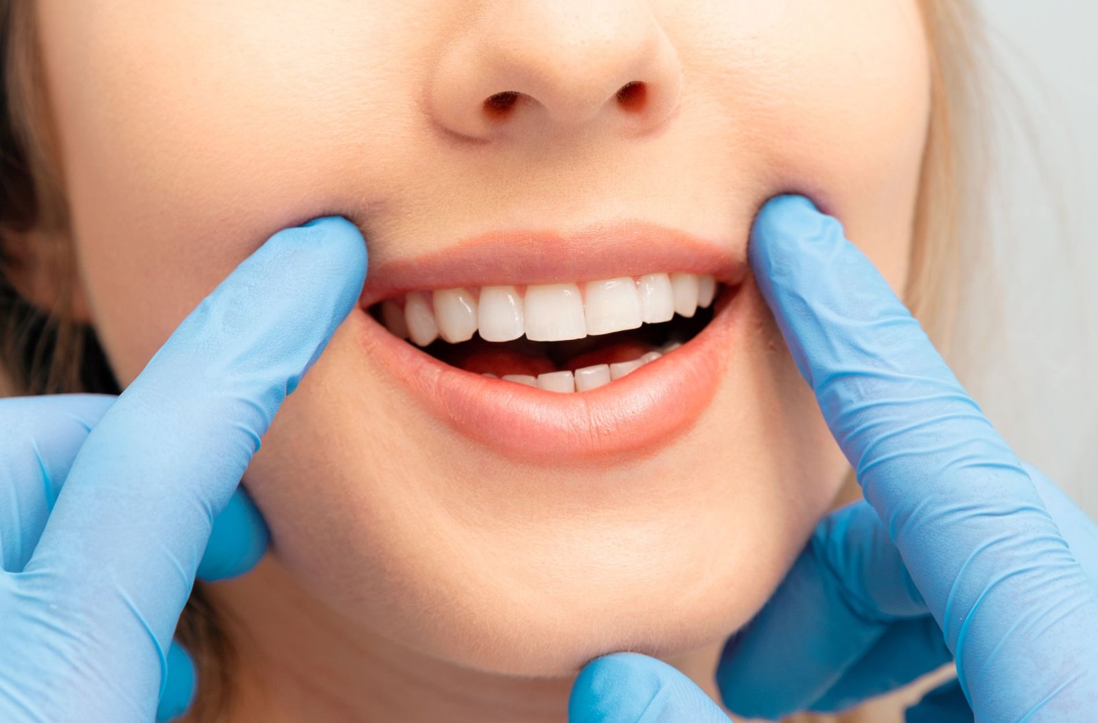 Composite Bonding