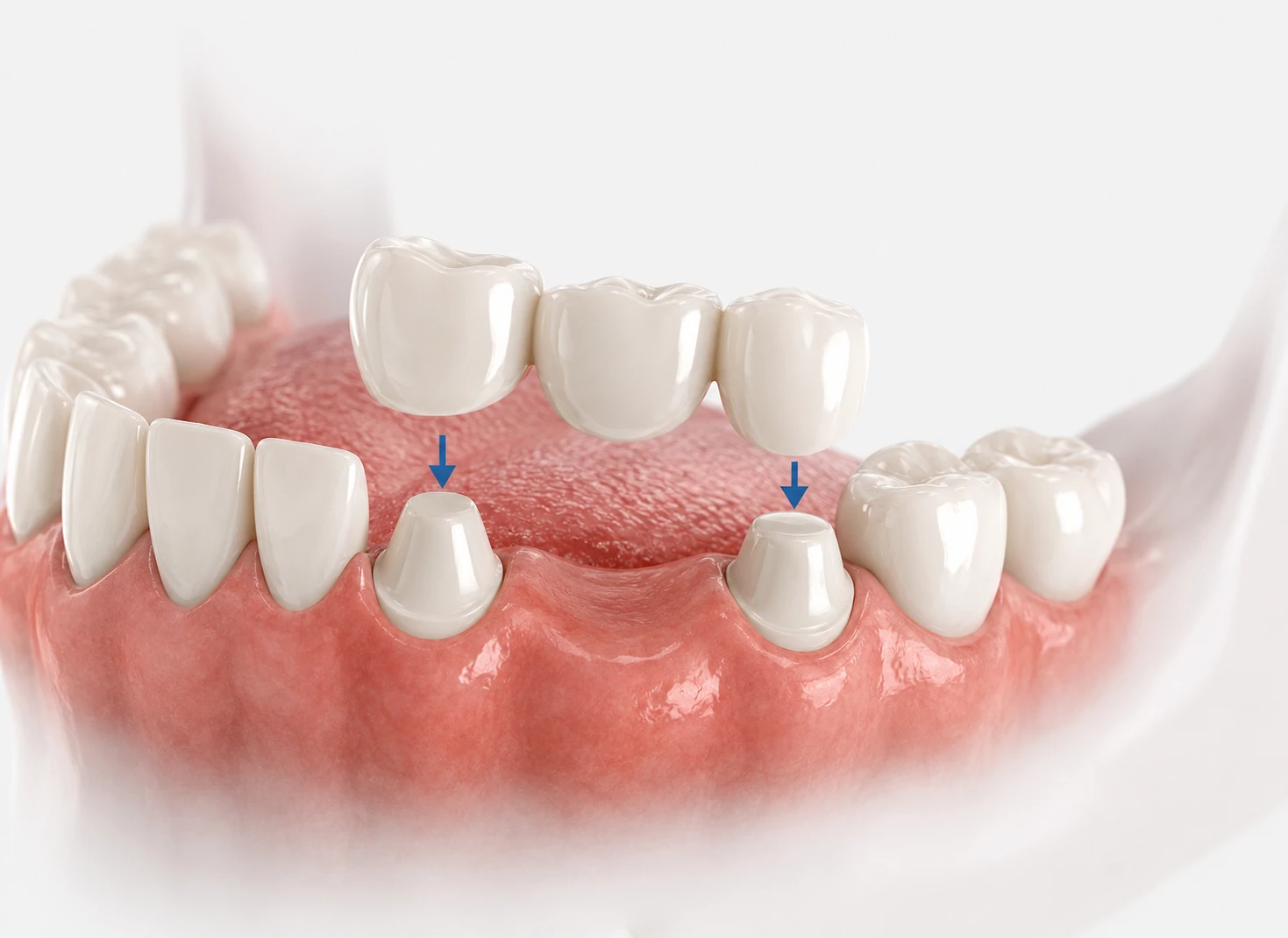 dental bridge the croft dental wilmslow