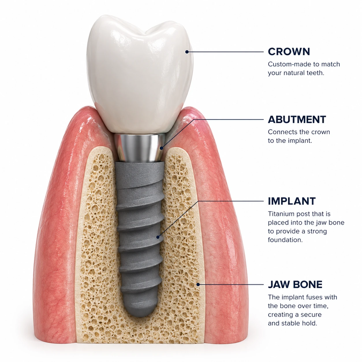 implant explained the croft dental wilmslow