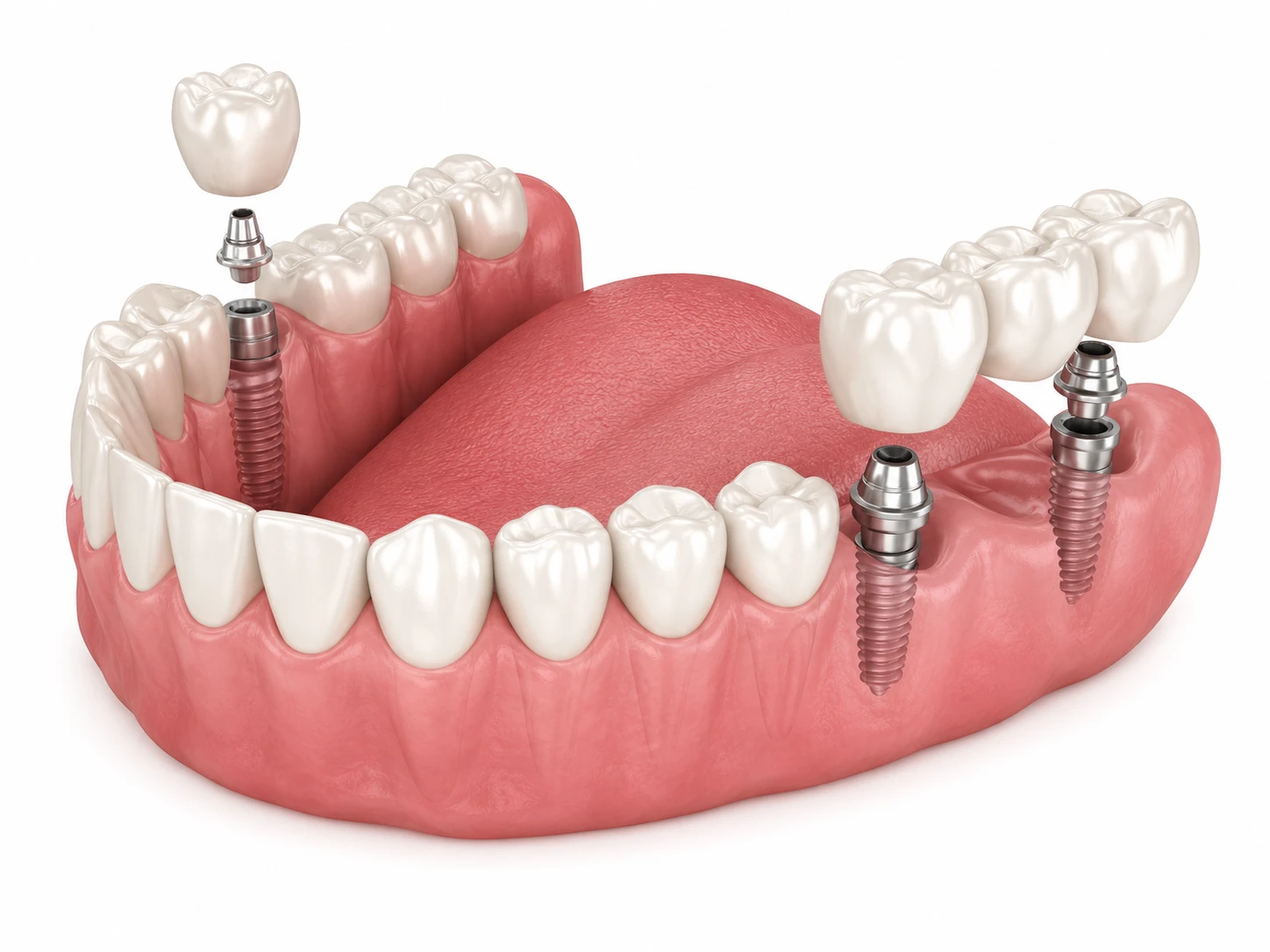 single and bridge implant the croft dental wilmslow