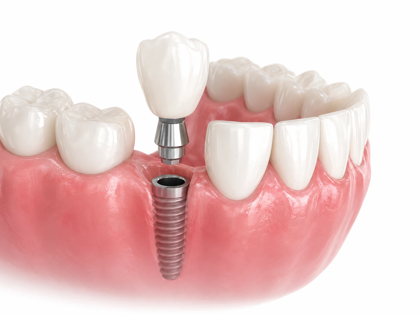 single tooth implant the croft dental wilmslow