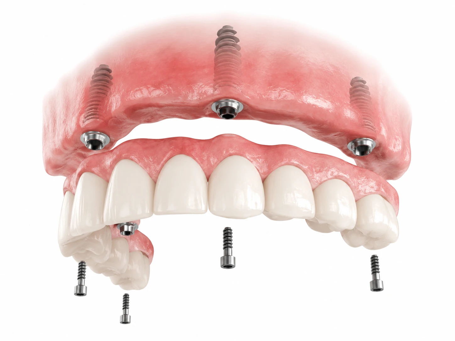upper arch dental implant the croft dental wilmslow