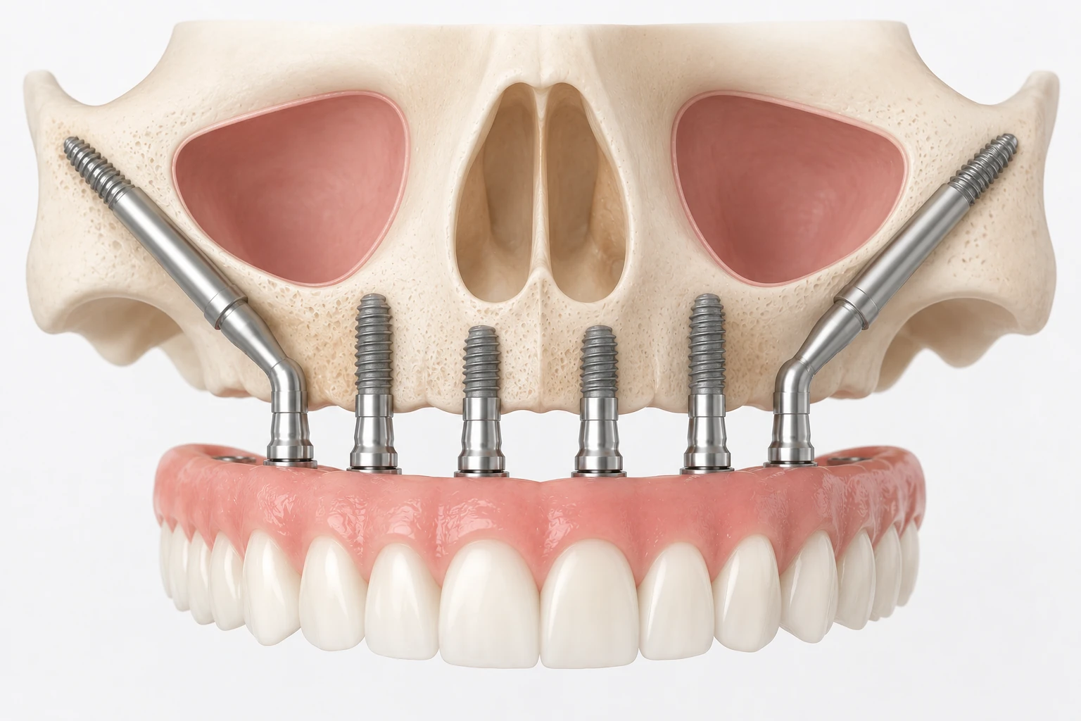 zygomatic implant the croft dental wilmslow